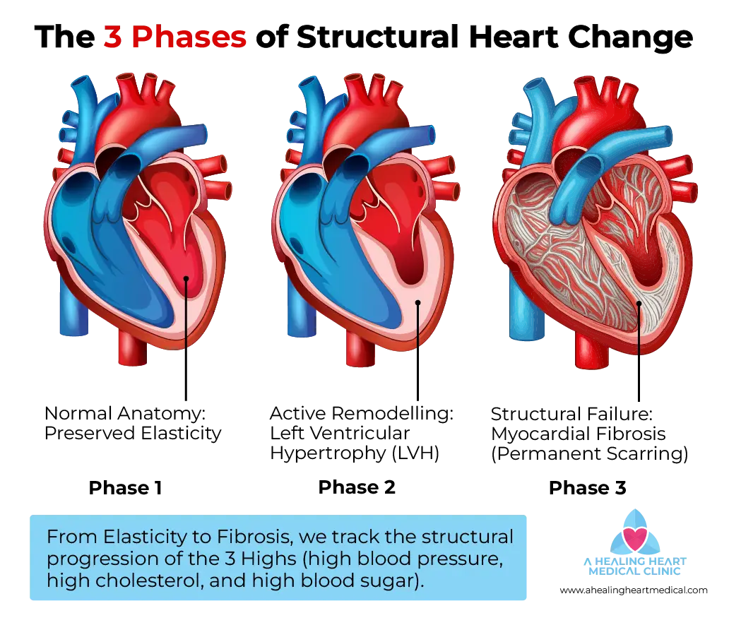 Infographic showing the 3 phases of structural heart change from healthy elasticity to myocardial fibrosis caused by high blood pressure, cholesterol, and sugar.