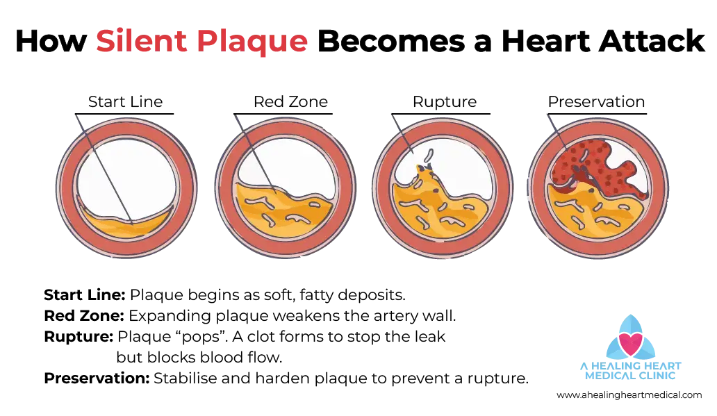 Diagram showing the progression of atherosclerosis from soft fatty plaque to rupture and blood clot formation.