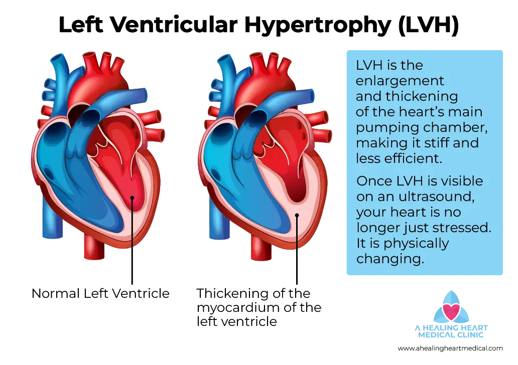 Comparison of a normal heart vs. Left Ventricular Hypertrophy (LVH) showing thickened muscle walls and reduced pumping chamber space.