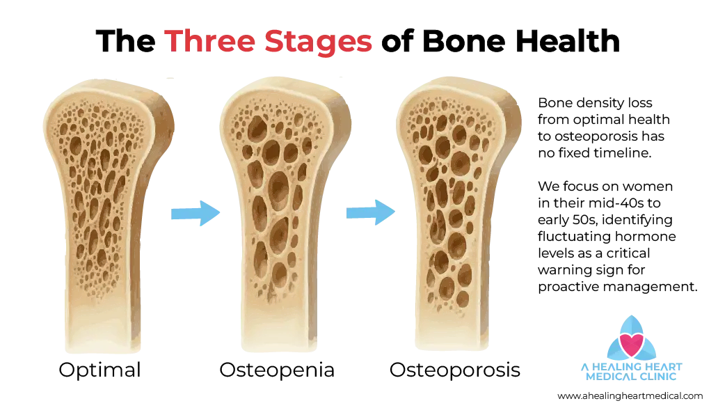 Vector illustration showing three stages of bone porosity progression